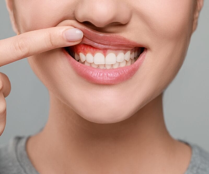 Is gingivitis contagious? 5 Common Ways Gum Disease is Spread