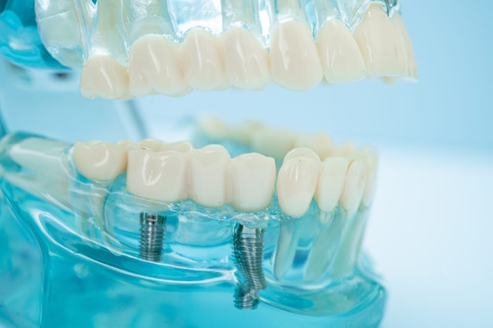 dental implants model