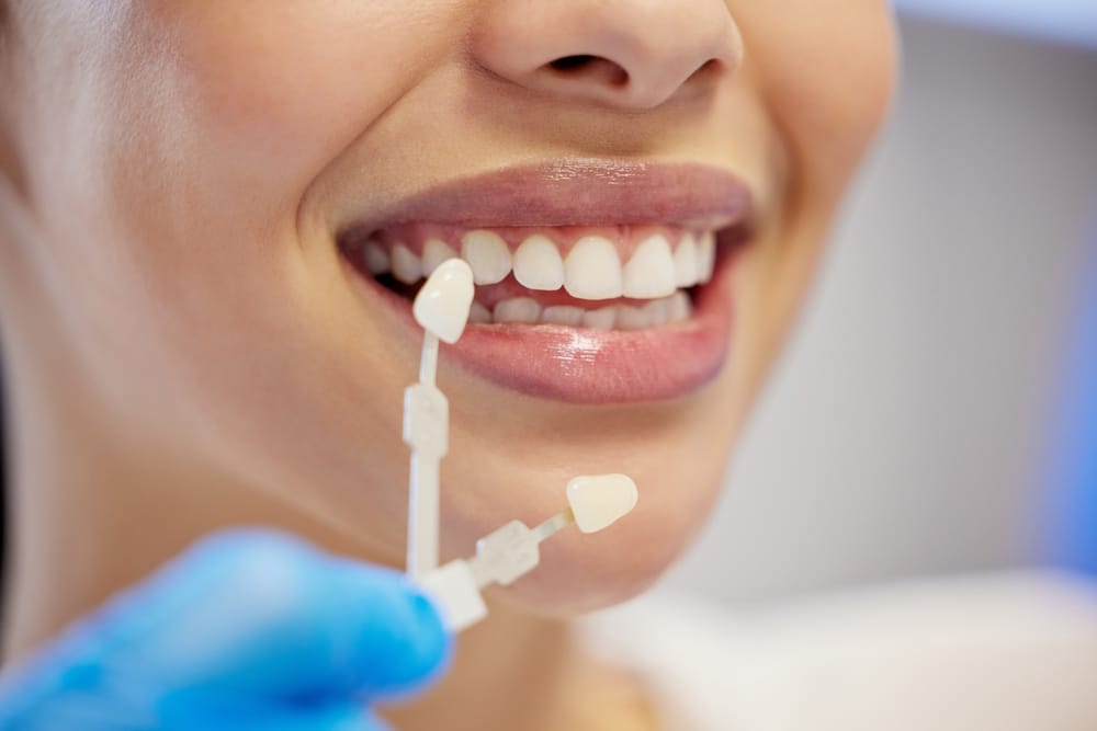Woman testing dental veneers - Dental Implants Kissimmee