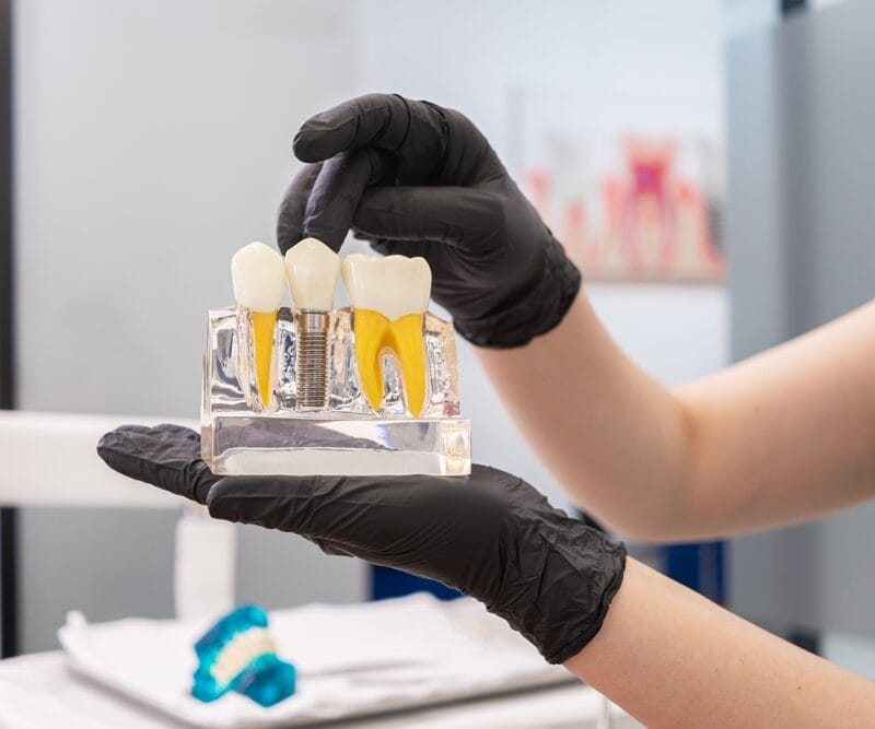 What are the 3 Types of Dental Implants? 5 Factors to Consider When Choosing Your Implant Type