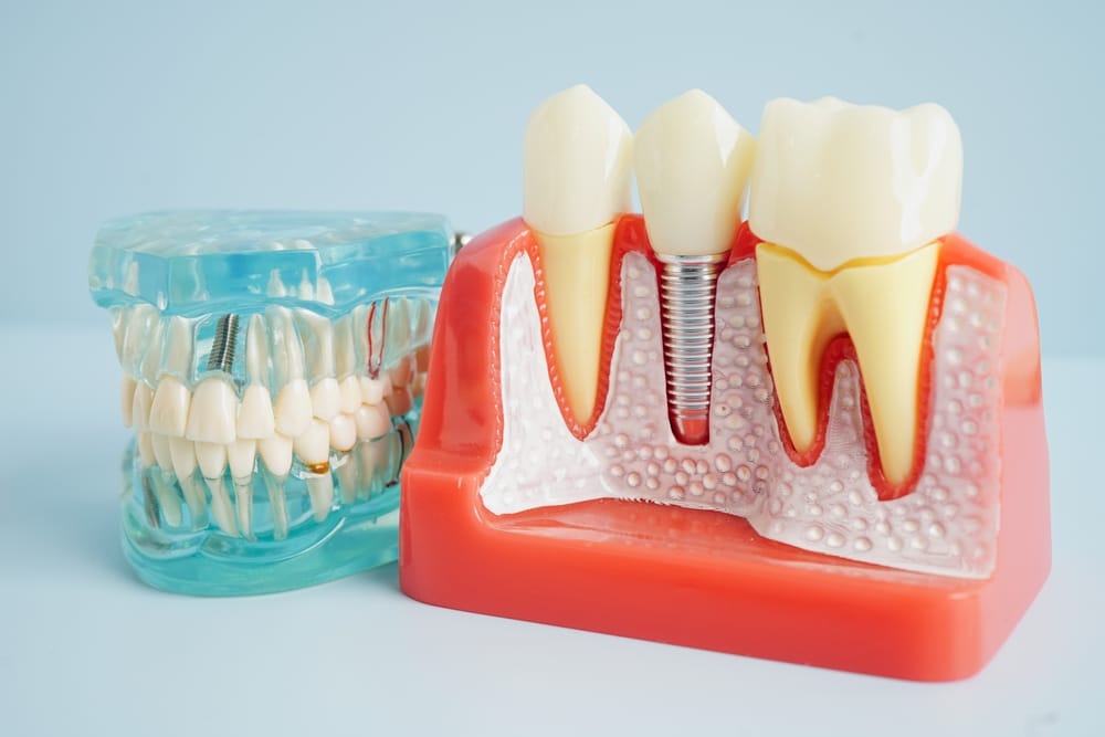 dental implants model