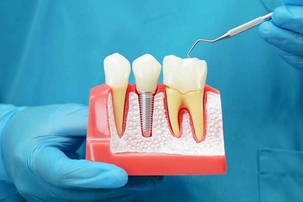dentist holding a teeth model explaining 