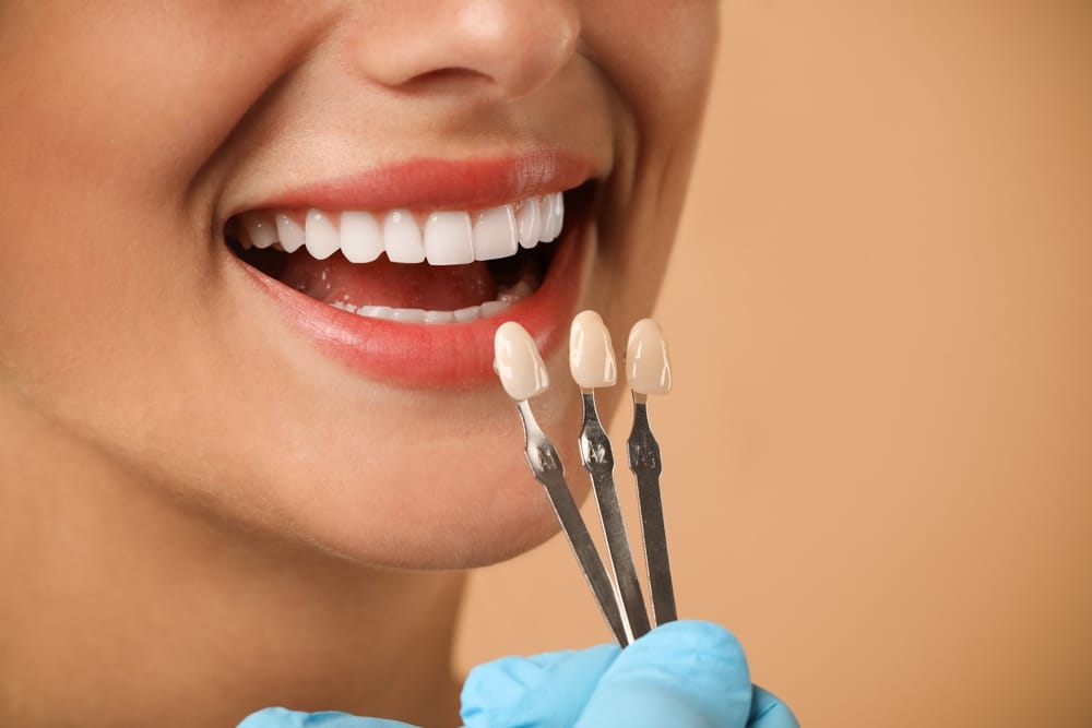 woman having a veneers